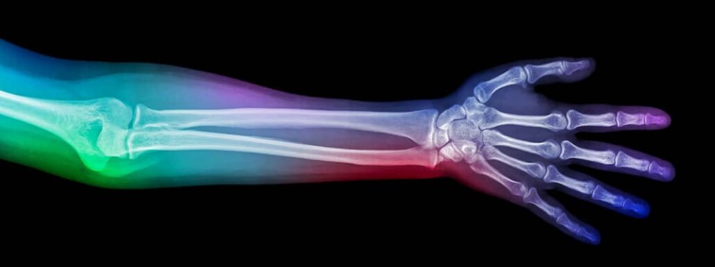 California Imaging and Diagnostics - Rainbow Xray of the arm